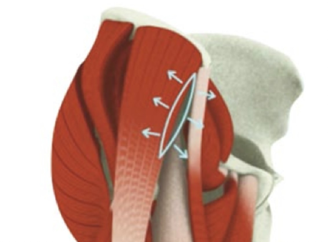 Veduta anteriore dell'anca destra: il corridoio fra tensore della fascia lata e sartorio viene aperto divaricando i muscoli, come indicano le frecce che si allontanano dall'apertura