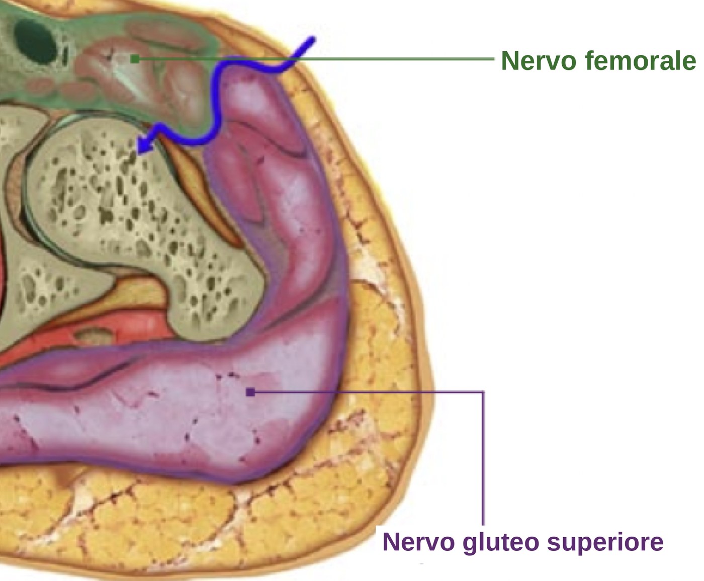 Cross-section of the right hip showing the femoral nerve territory in green and the superior gluteal nerve territory in purple, with the direct anterior approach passing between them