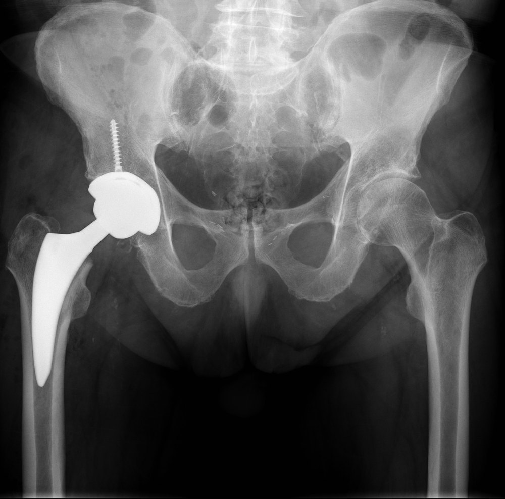Radiografia preoperatoria