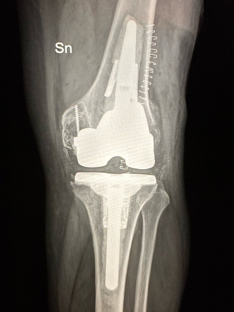 Radiografia post-operatoria AP