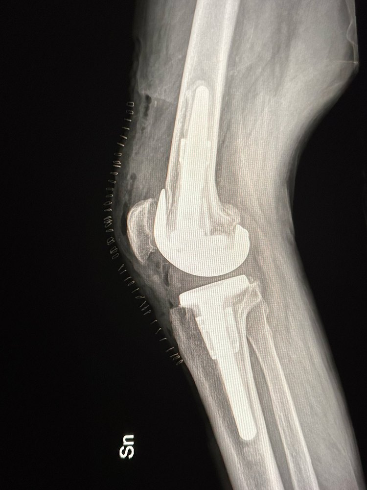Radiografia post-operatoria laterale