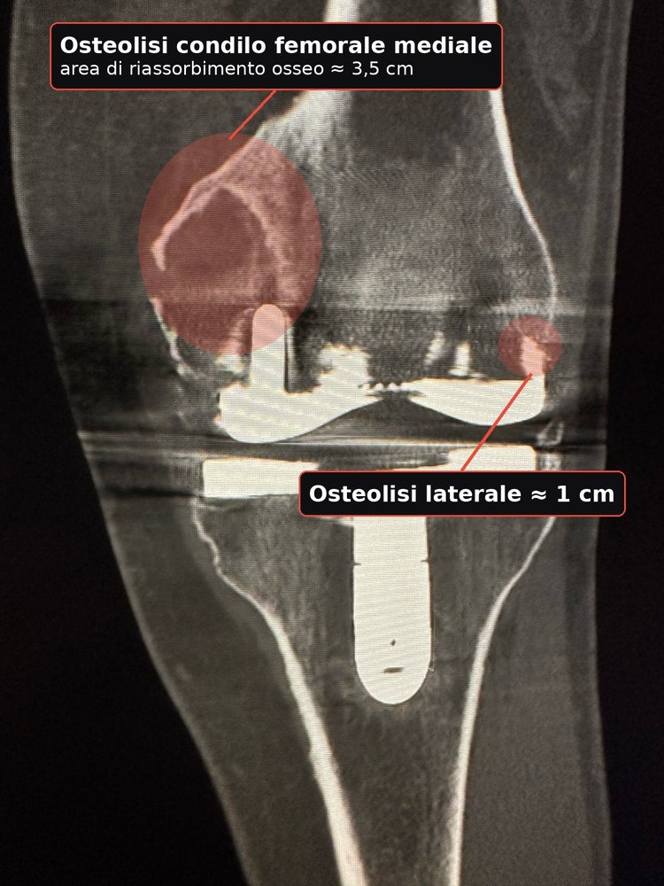 TC preoperatoria con le aree di osteolisi