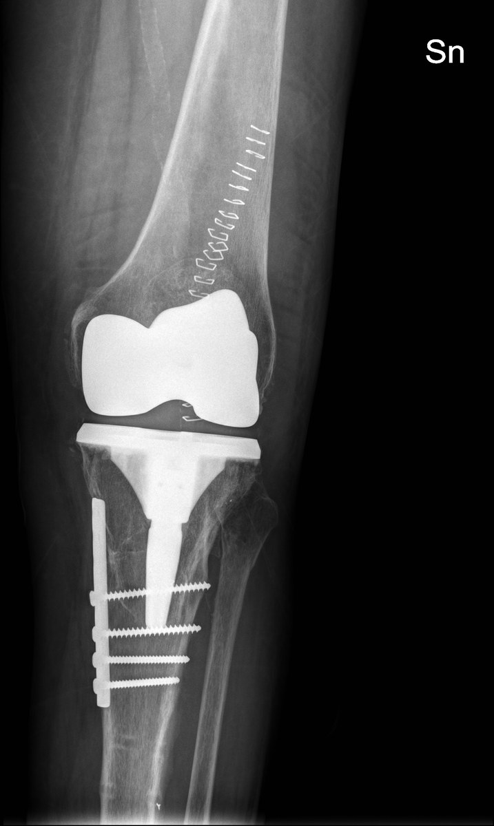 Risultato radiografico dell'impianto pianificato