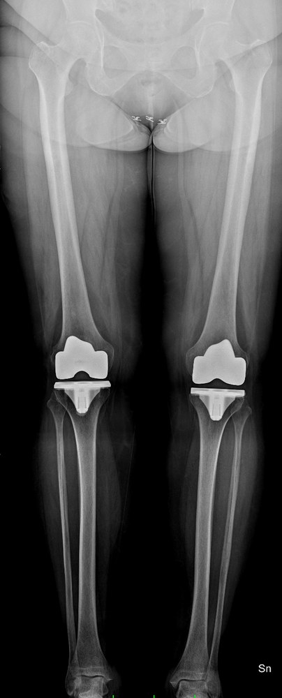 Radiografia postoperatoria sotto carico: asse dell'arto ripristinato