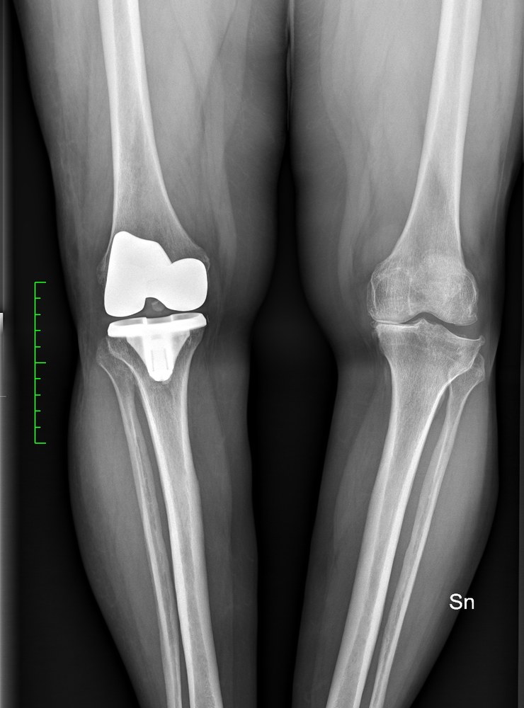 Radiografia preoperatoria: gonartrosi del ginocchio da operare