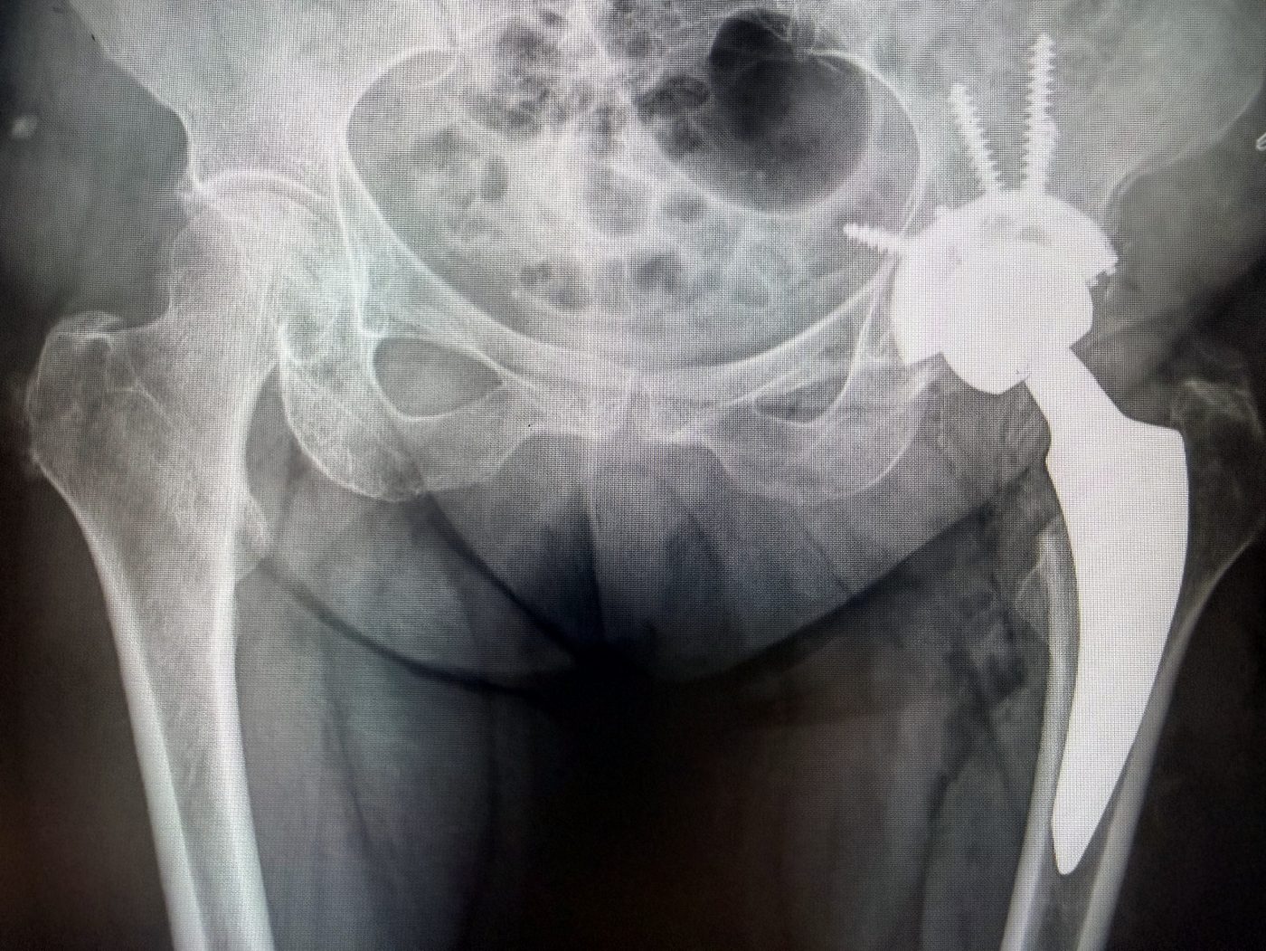 Radiografia dopo l’intervento