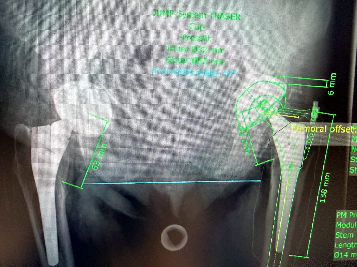 Planning digitale preoperatorio della revisione d'anca