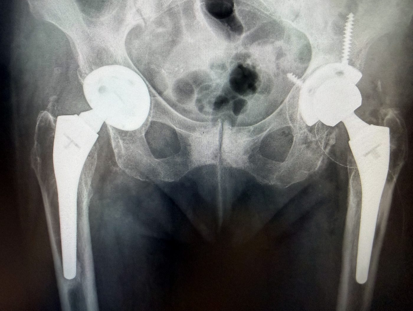 Radiografia dopo l’intervento