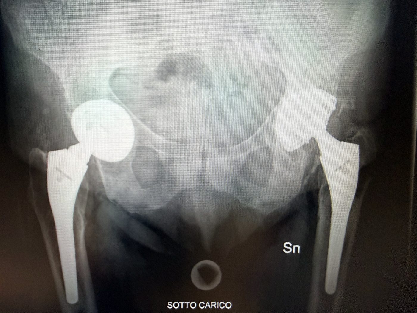 Radiografia sotto carico: usura dell'inserto in polietilene dell'anca sinistra