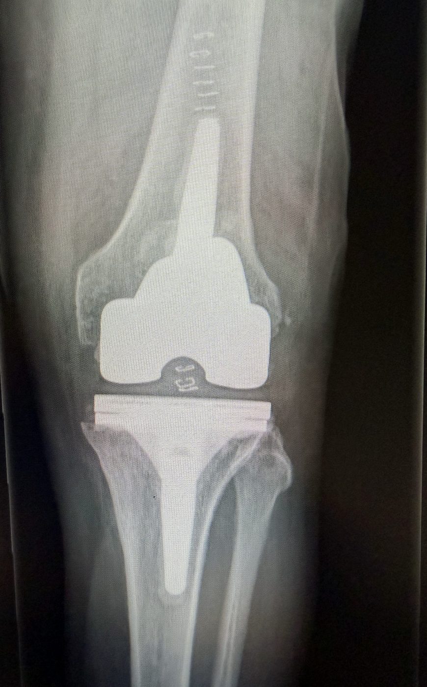 Radiografia post-operatoria antero-posteriore dopo revisione light