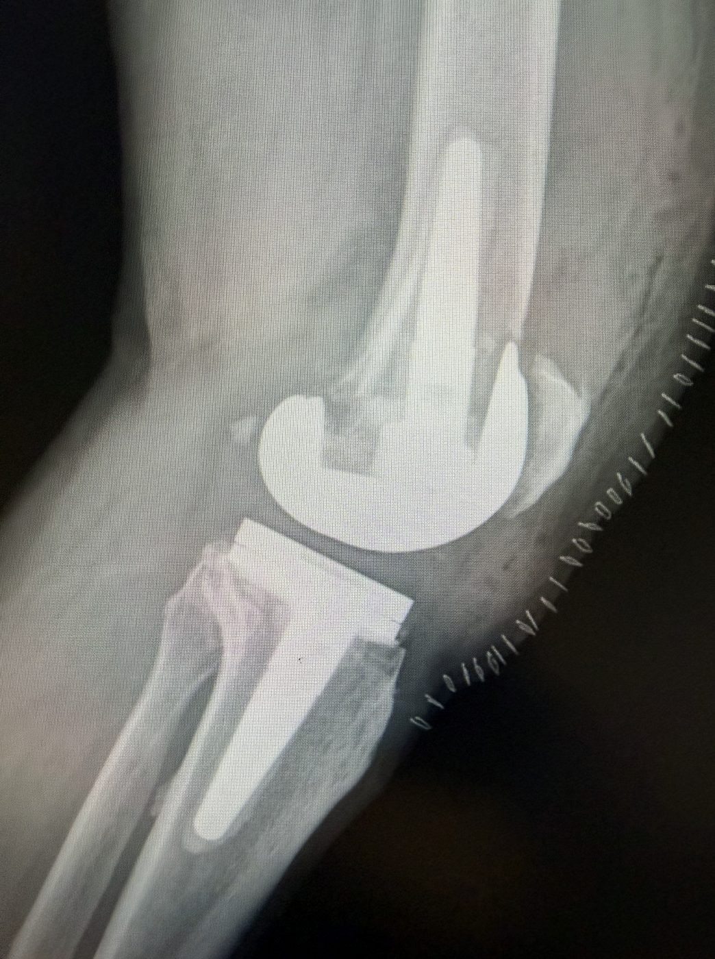 Radiografia post-operatoria laterale dopo revisione light