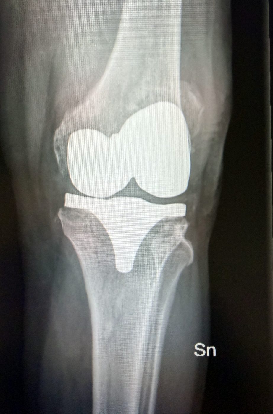 Radiografia pre-operatoria antero-posteriore