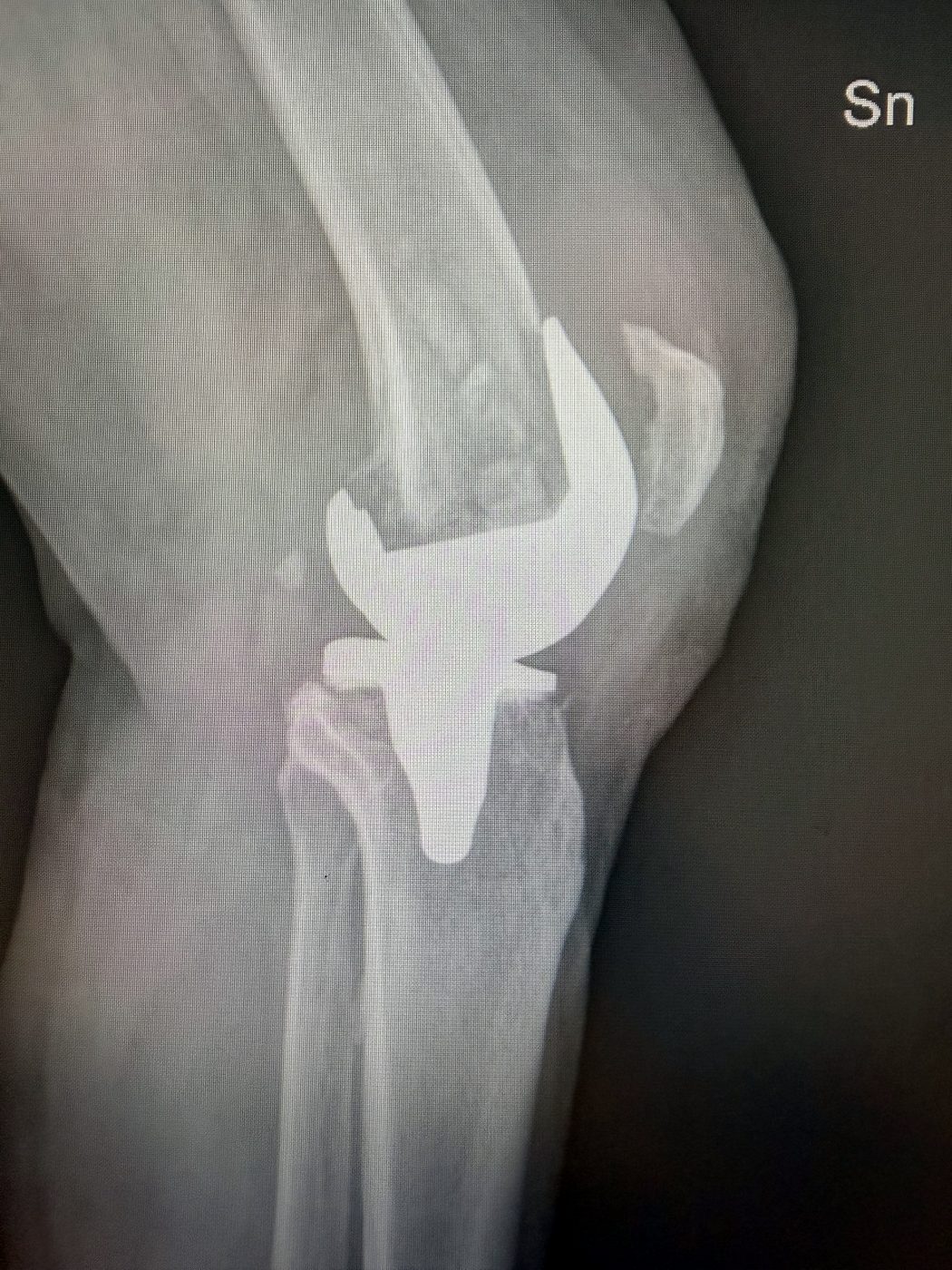 Radiografia pre-operatoria laterale