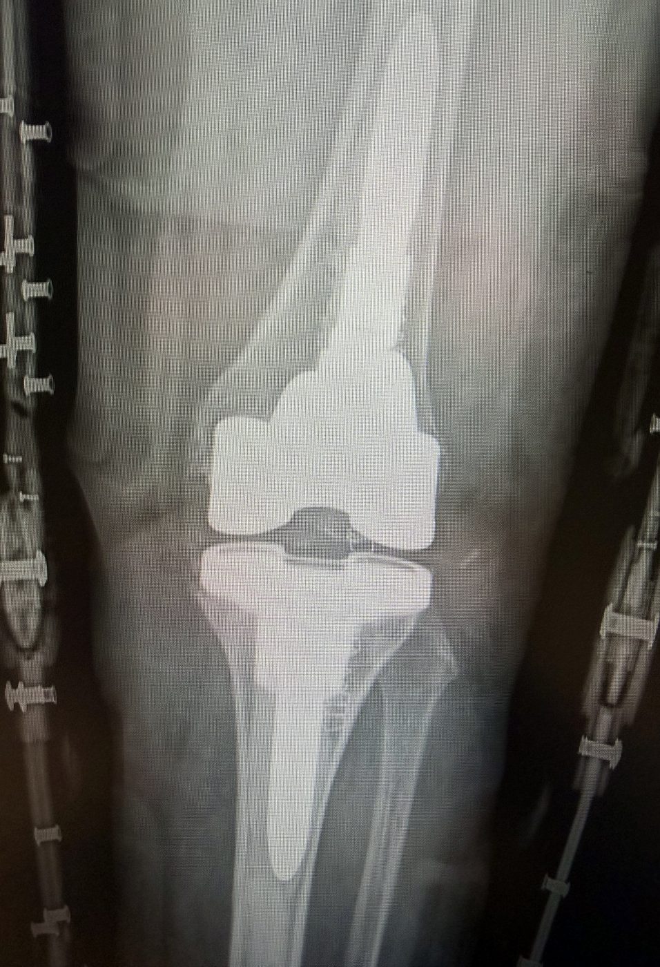 Radiografia post-operatoria in proiezione antero-posteriore