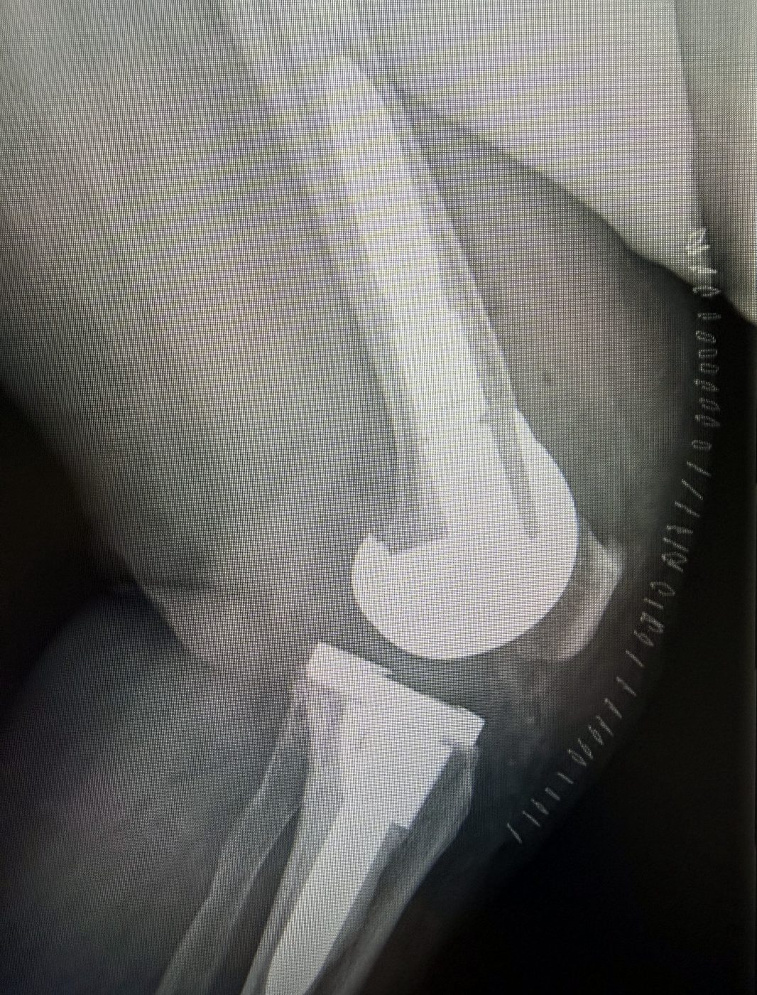 Radiografia post-operatoria in proiezione laterale