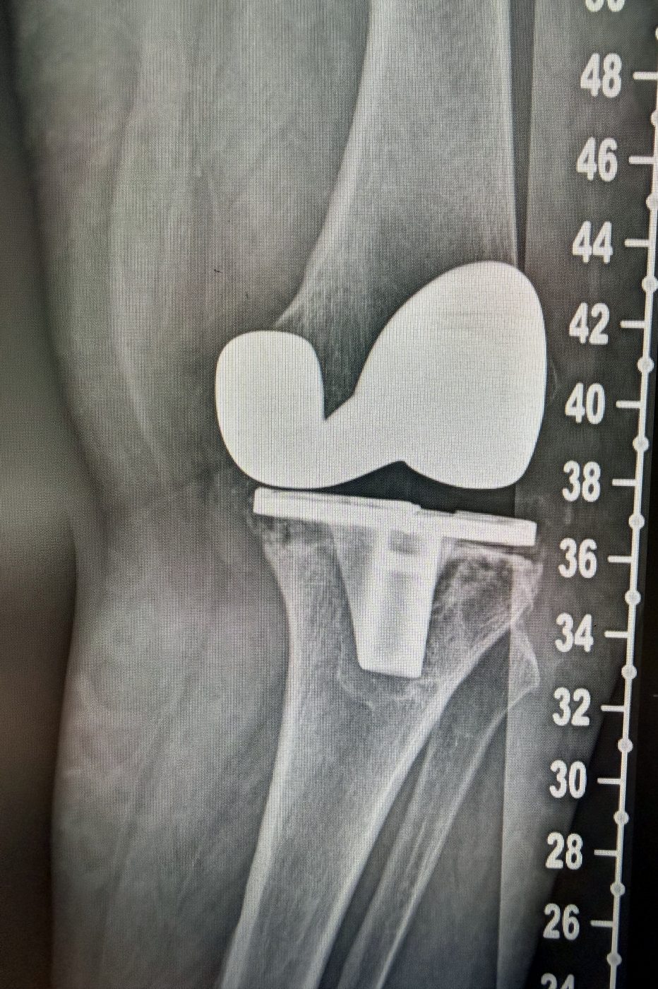Radiografia laterale pre-operatoria: usura del polietilene e osteolisi