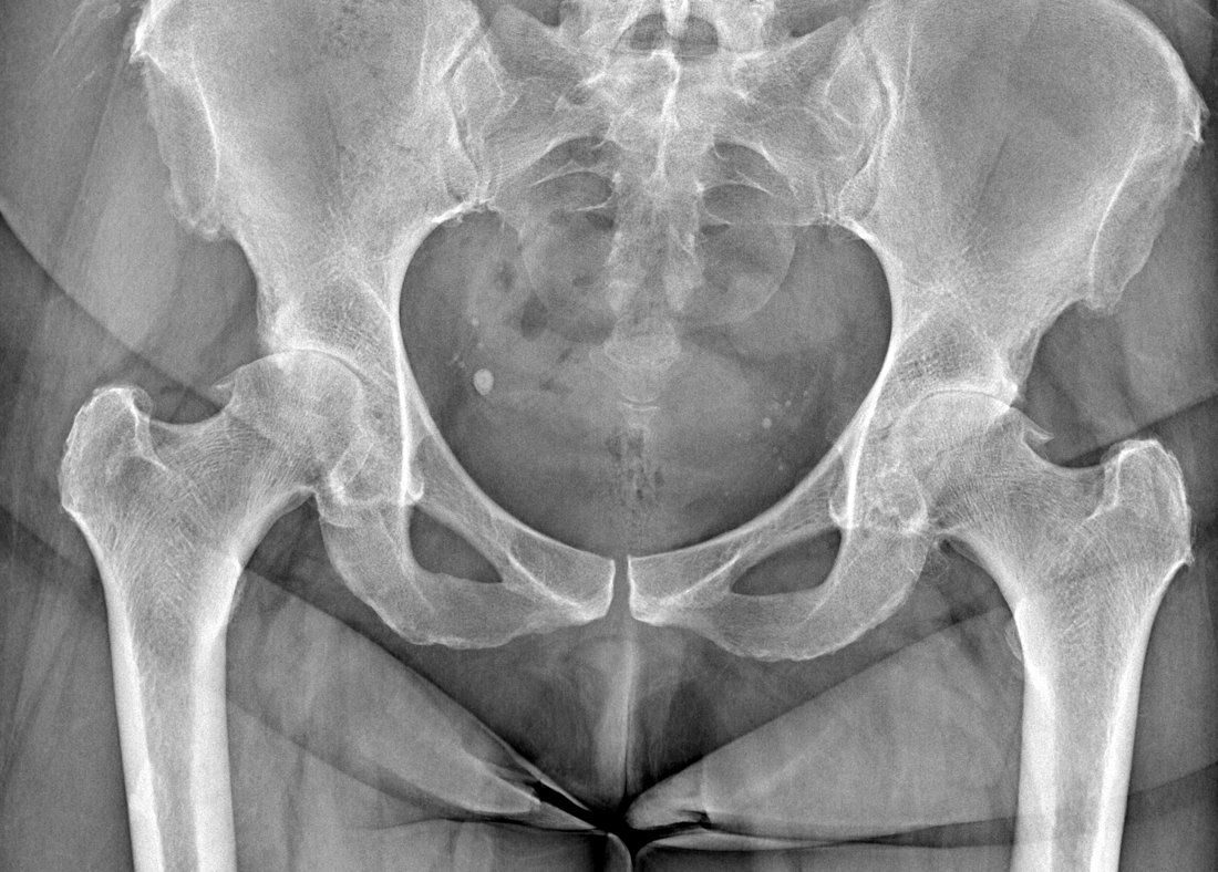 Coxartrosi primaria — quadro radiografico