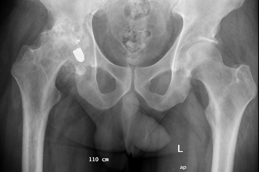 Coxartrosi secondaria — quadro radiografico