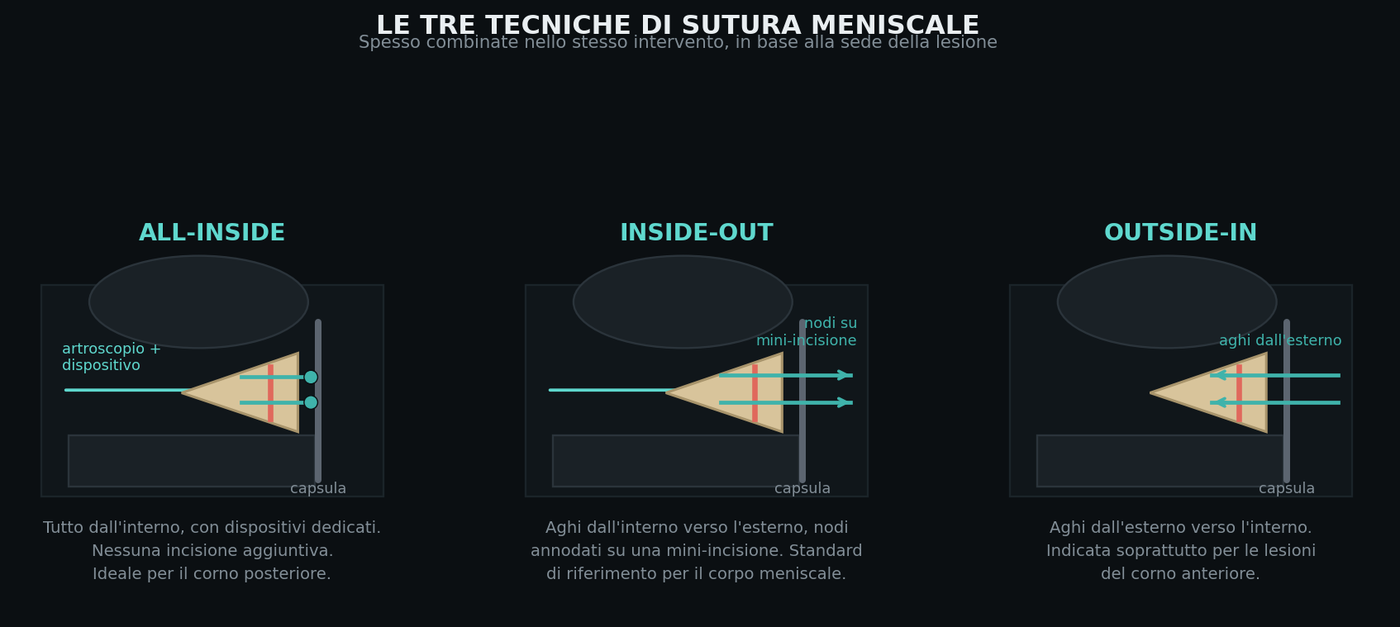 Le tre tecniche di sutura, spesso combinate nello stesso intervento in base alla sede della lesione.