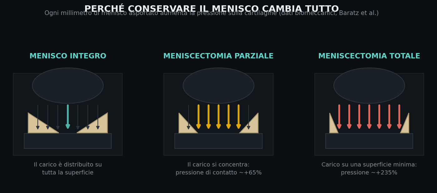 Con il menisco integro il carico è distribuito. Dopo una meniscectomia parziale la pressione di contatto aumen
