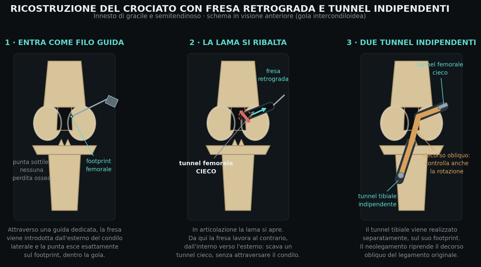 Schema: ricostruzione del crociato con fresa retrograda e due tunnel indipendenti